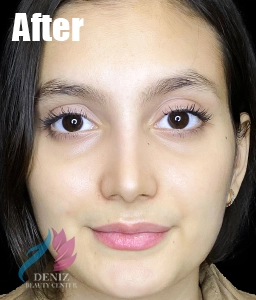 عکس قبل و بعد از عمل بینی طبیعی مجموعه زیبایی دنیز10