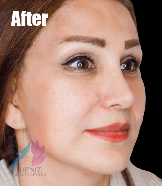 عکس قبل و بعد لیفت صورت با جراحی مجموعه زیبایی دنیز