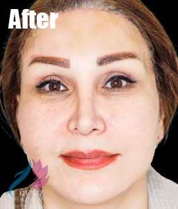 عکس قبل و بعد لیفت صورت با جراحی مجموعه زیبایی دنیز3