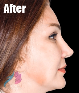 عکس قبل و بعد لیفت صورت با جراحی مجموعه زیبایی دنیز4
