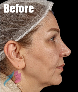 عکس قبل و بعد لیفت صورت با جراحی مجموعه زیبایی دنیز1