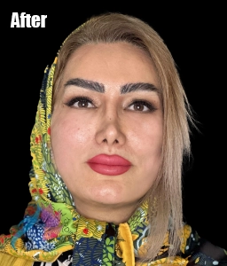 کشیدن پوست صورت بدون عمل جراحی کلینیک دنیز8