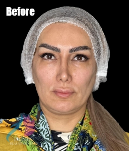 کشیدن پوست صورت بدون عمل جراحی کلینیک دنیز9