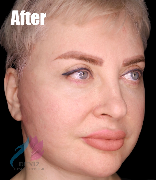 عکس قبل و بعد لیفت صورت با جراحی مجموعه زیبایی دنیز5