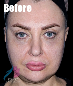 عکس قبل و بعد لیفت صورت با جراحی مجموعه زیبایی دنیز7