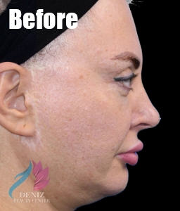 عکس قبل و بعد لیفت صورت با جراحی مجموعه زیبایی دنیز8