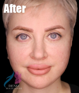 عکس قبل و بعد لیفت صورت با جراحی مجموعه زیبایی دنیز9