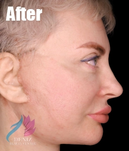 عکس قبل و بعد لیفت صورت با جراحی مجموعه زیبایی دنیز6