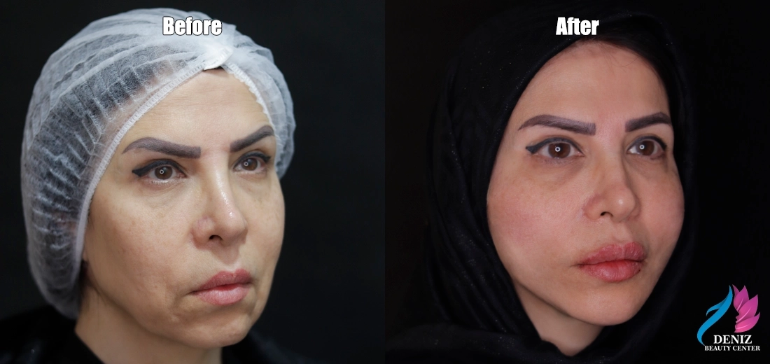 لیفت صورت با نخ برای چه سنی مناسب است کلینیک جراحی زیبایی دنیز در تهران