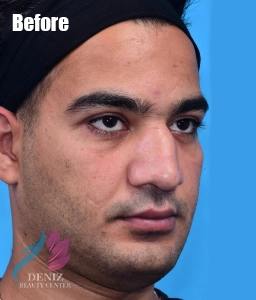 عکس قبل و بعد عمل بینی استخوانی مجموعه زیبایی دنیز2