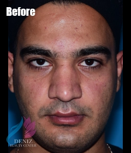 عکس قبل و بعد عمل بینی استخوانی مجموعه زیبایی دنیز3