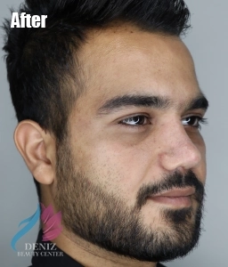 عکس قبل و بعد عمل بینی استخوانی مجموعه زیبایی دنیز1