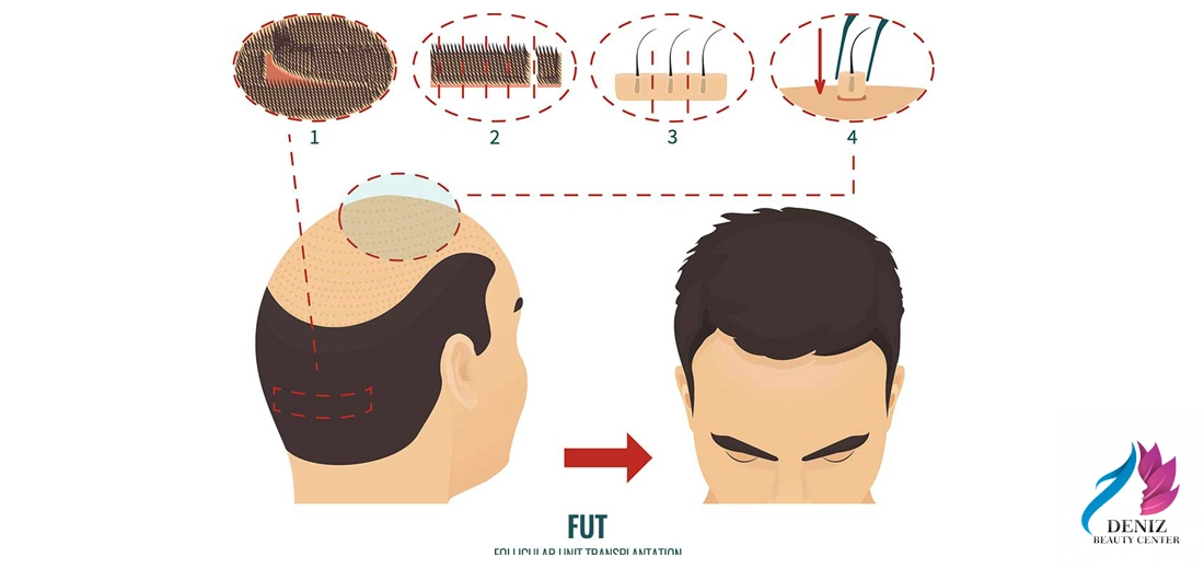 کاشت مو به روش FUT مجموعه زیبایی دنیز